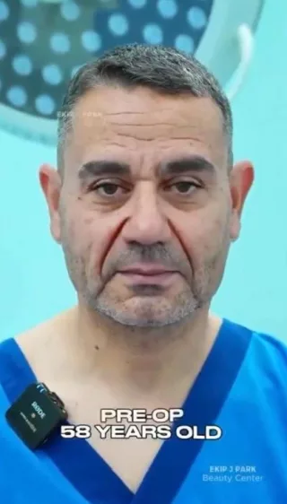58-летний мужчина из Турции после подтяжки лица во Вьетнаме
